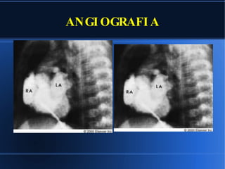 ANGIOGRAFIA 
