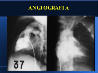 ANGIOGRAFIA 