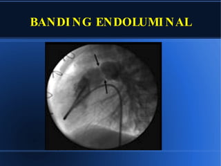 BANDING ENDOLUMINAL 