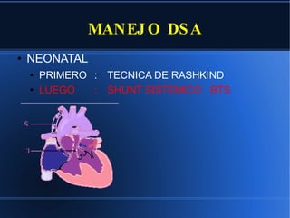 MANEJO DSA NEONATAL PRIMERO : TECNICA DE RASHKIND LUEGO  :  SHUNT SISTEMICO  BTS 