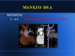 MANEJO DSA NEONATAL 3 – 4 A : DERIVACION ATRIOPULM FONTAN 