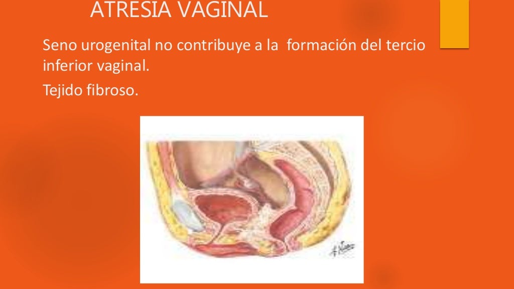 Atresia Vaginal Atresia Vaginal