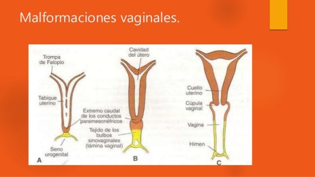 Vaginal Atresia Types M llerian Agenesis Diagnosis Management And Vaginal Atresia Types M llerian Agenesis Diagnosis Management And