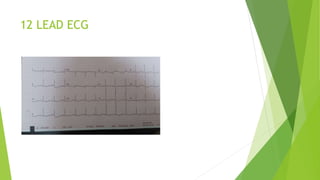 12 LEAD ECG