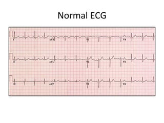 Normal EKGNormal ECG
 