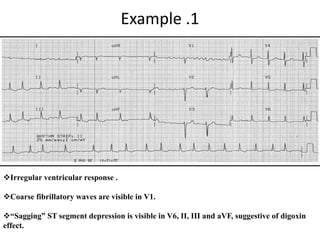 Example .1
Irregular ventricular response .
Coarse fibrillatory waves are visible in V1.
“Sagging” ST segment depression is visible in V6, II, III and aVF, suggestive of digoxin
effect.
 
