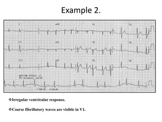 Example 2.
Irregular ventricular response.
Coarse fibrillatory waves are visible in V1.
 