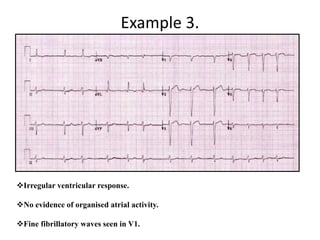 Example 3.
Irregular ventricular response.
No evidence of organised atrial activity.
Fine fibrillatory waves seen in V1.
 