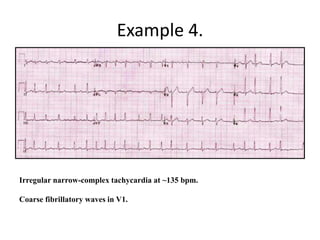 Example 4.
Irregular narrow-complex tachycardia at ~135 bpm.
Coarse fibrillatory waves in V1.
 