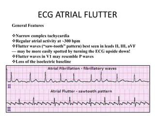 ECG ATRIAL FLUTTER
General Features
Narrow complex tachycardia
Regular atrial activity at ~300 bpm
Flutter waves (“saw-tooth” pattern) best seen in leads II, III, aVF
— may be more easily spotted by turning the ECG upside down!
Flutter waves in V1 may resemble P waves
Loss of the isoelectric baseline
 