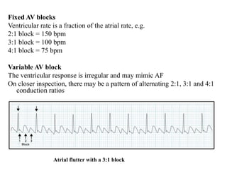 Fixed AV blocks
Ventricular rate is a fraction of the atrial rate, e.g.
2:1 block = 150 bpm
3:1 block = 100 bpm
4:1 block = 75 bpm
Variable AV block
The ventricular response is irregular and may mimic AF
On closer inspection, there may be a pattern of alternating 2:1, 3:1 and 4:1
conduction ratios
Atrial flutter with a 3:1 block
 