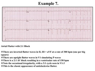 Example 7.
Atrial Flutter with 2:1 Block
There are inverted flutter waves in II, III + aVF at a rate of 300 bpm (one per big
square)
There are upright flutter waves in V1 simulating P waves
There is a 2:1 AV block resulting in a ventricular rate of 150 bpm
Note the occasional irregularity, with a 3:1 cycle seen in V1-3
This is the classic appearance of anticlockwise flutter.
 