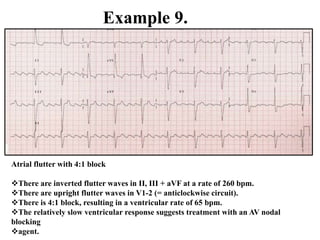 Example 9.
Atrial flutter with 4:1 block
There are inverted flutter waves in II, III + aVF at a rate of 260 bpm.
There are upright flutter waves in V1-2 (= anticlockwise circuit).
There is 4:1 block, resulting in a ventricular rate of 65 bpm.
The relatively slow ventricular response suggests treatment with an AV nodal
blocking
agent.
 
