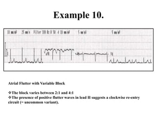 Example 10.
Atrial Flutter with Variable Block
The block varies between 2:1 and 4:1
The presence of positive flutter waves in lead II suggests a clockwise re-entry
circuit (= uncommon variant).
 