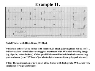 Example 11.
Atrial Flutter with High-Grade AV Block
There is anticlockwise flutter with marked AV block (varying from 5:1 up to 8:1).
The very low ventricular rate suggests treatment with AV nodal blocking drugs
(e.g.digoxin, beta-blockers). Other possibilities could include intrinsic conducting
system disease (true “AV block”) or electrolyte abnormality (e.g. hyperkalaemia).
Tip: The combination of new-onset atrial flutter with high-grade AV block is very
suspicious for digoxin toxicity.
 