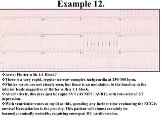 Example 12.
Atrial Flutter with 1:1 Block?
There is a very rapid, regular narrow-complex tachycardia at 250-300 bpm.
Flutter waves are not clearly seen, but there is an undulation to the baseline in the
inferior leads suggestive of flutter with a 1:1 block.
Alternatively, this may just be rapid SVT (AVNRT / AVRT) with rate-related ST
depression.
With ventricular rates as rapid as this, spending any further time evaluating the ECG is
unwise! Resuscitation is the priority. This patient will almost certainly be
haemodynamically unstable, requiring emergent DC cardioversion.
 