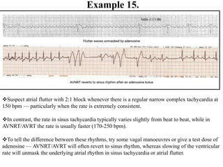 Example 15.
Suspect atrial flutter with 2:1 block whenever there is a regular narrow complex tachycardia at
150 bpm — particularly when the rate is extremely consistent.
In contrast, the rate in sinus tachycardia typically varies slightly from beat to beat, while in
AVNRT/AVRT the rate is usually faster (170-250 bpm).
To tell the difference between these rhythms, try some vagal manoeuvres or give a test dose of
adenosine — AVNRT/AVRT will often revert to sinus rhythm, whereas slowing of the ventricular
rate will unmask the underlying atrial rhythm in sinus tachycardia or atrial flutter.
 