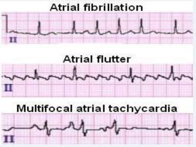 heart flutter vs afib heart flutter vs afib