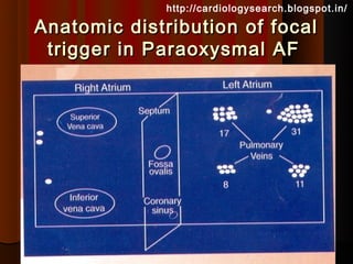 http://cardiologysearch.blogspot.in/

Anatomic distribution of focal
 trigger in Paraoxysmal AF
 