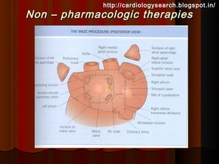 http://cardiologysearch.blogspot.in/
Non – pharmacologic therapies
 