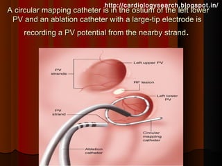http://cardiologysearch.blogspot.in/
A circular mapping catheter is in the ostium of the left lower
 PV and an ablation catheter with a large-tip electrode is
     recording a PV potential from the nearby strand.
 