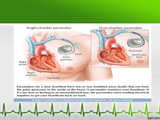 Atrial fibrillation & Atrial flutter | PPTX