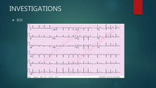 INVESTIGATIONS
 ECG
 