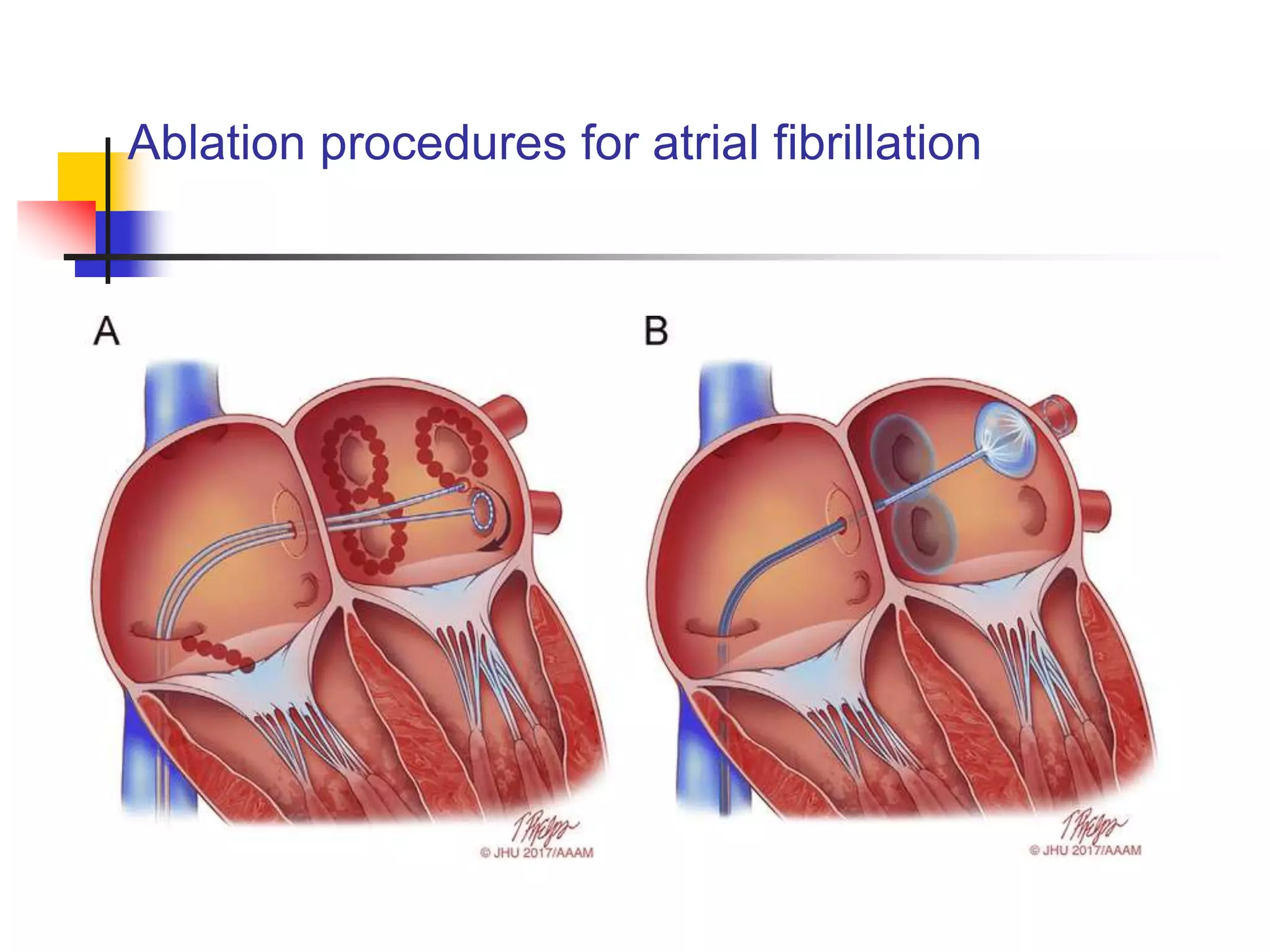Ablation procedures for atrial fibrillation
 