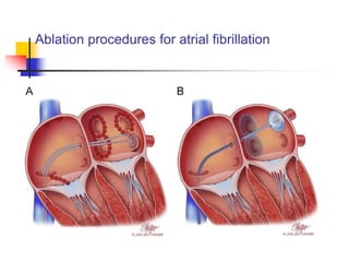 Atrial Fibrillation By Dr Joshua Walinjom.ppt