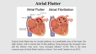 Atrial Fibrillation and difference with Atrial flutter | PPTX