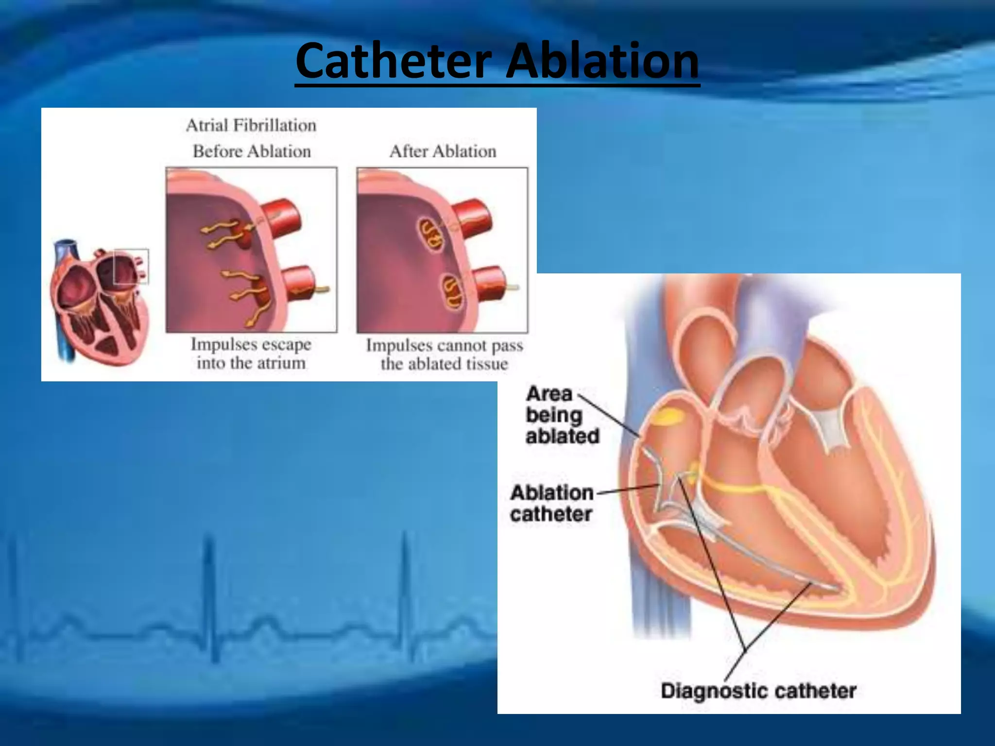 Catheter Ablation 
 