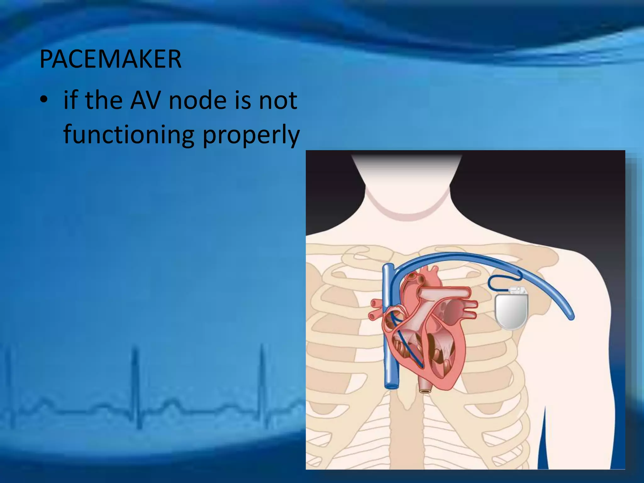 PACEMAKER 
• if the AV node is not 
functioning properly 
 