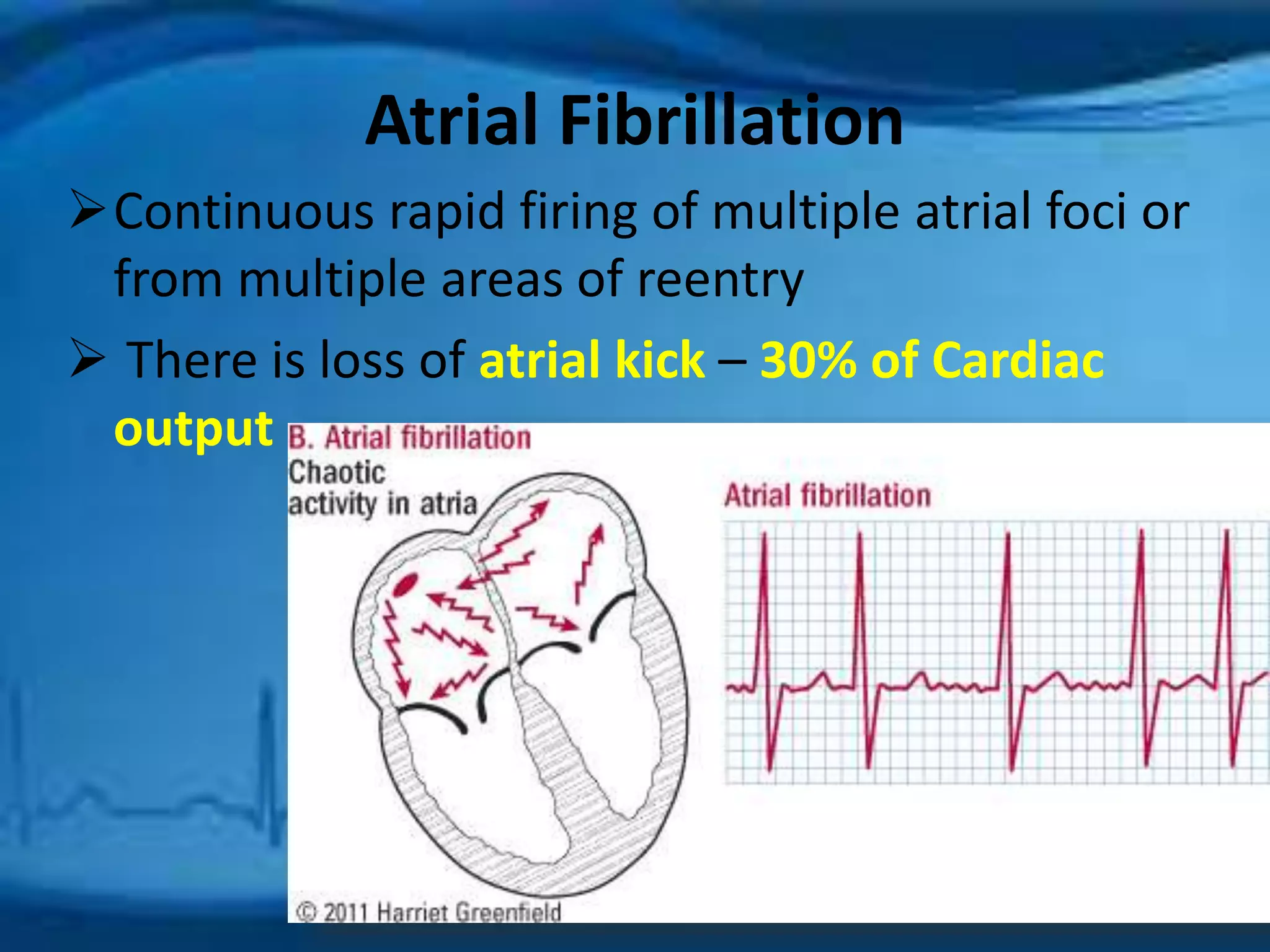 Atrial Fibrillation 
Continuous rapid firing of multiple atrial foci or 
from multiple areas of reentry 
 There is loss of atrial kick – 30% of Cardiac 
output 
 