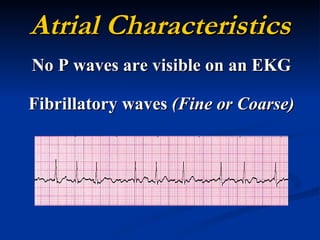 Atrial Characteristics No P waves are visible on an EKG Fibrillatory waves  (Fine or Coarse) 