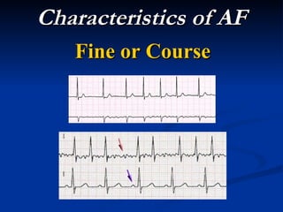 Characteristics of AF Fine or Course 