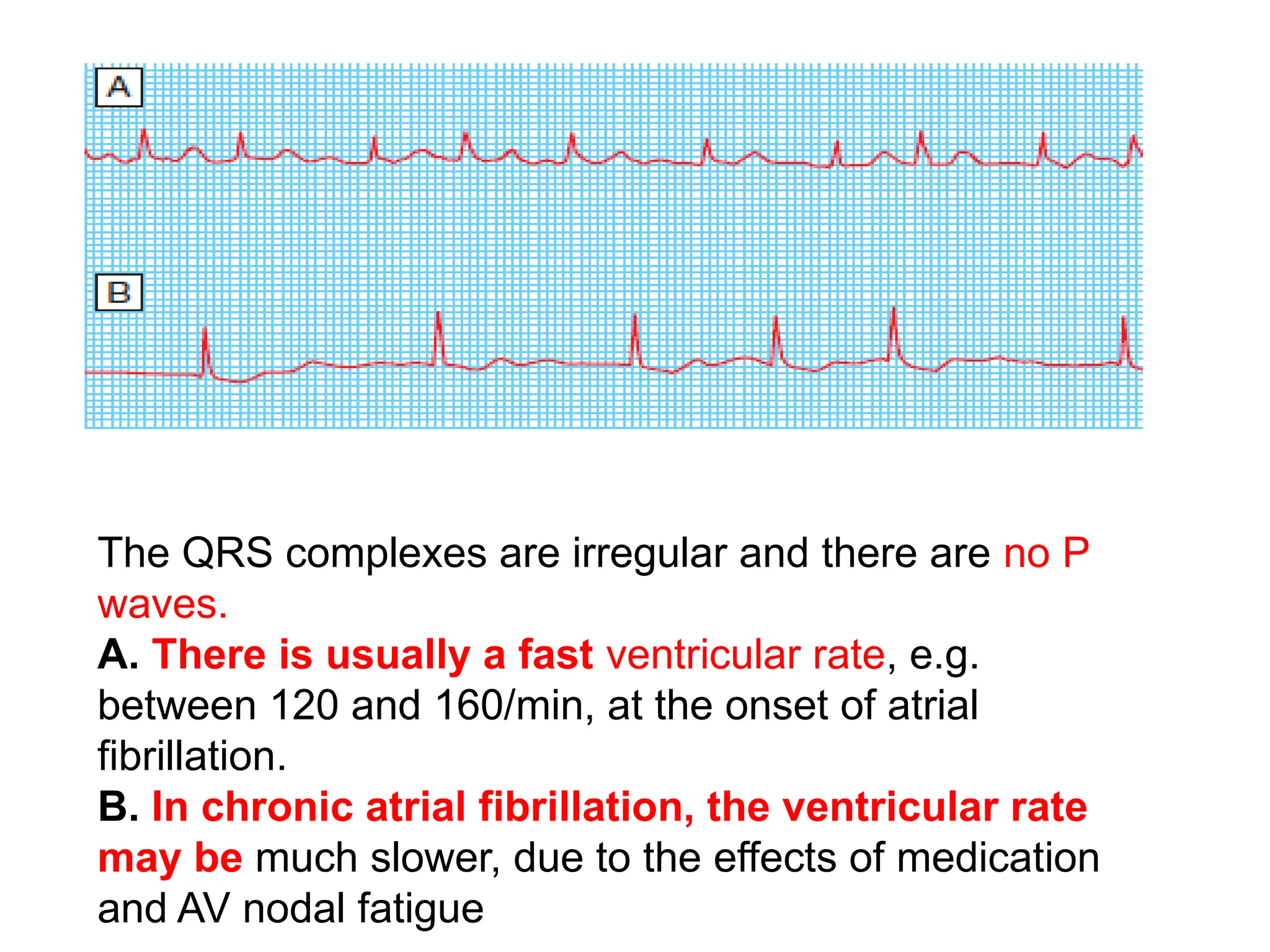 atrialfibrillationanishautosaved-190529100148.ppt