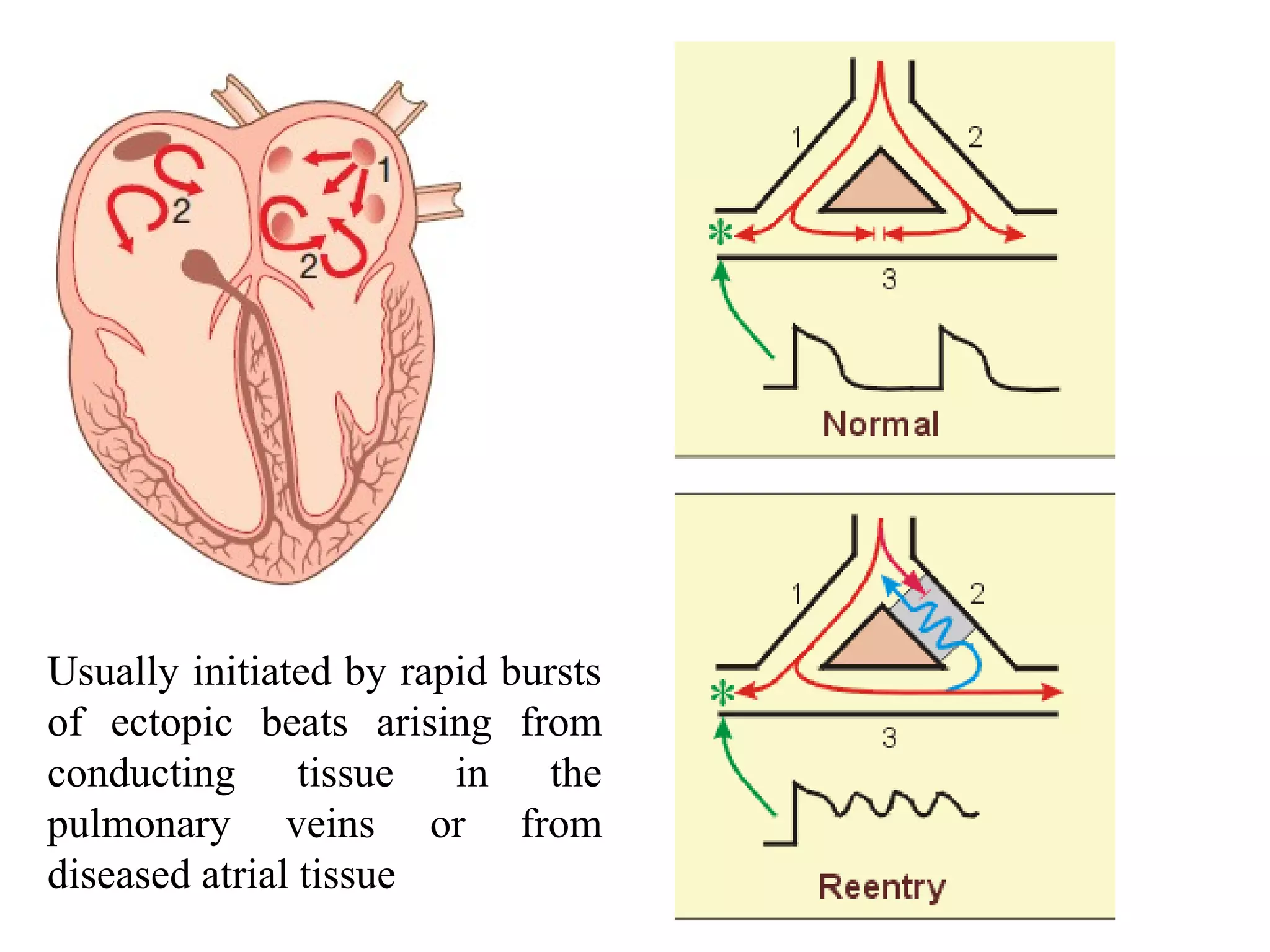Usually initiated by rapid bursts
of ectopic beats arising from
conducting tissue in the
pulmonary veins or from
diseased atrial tissue
 
