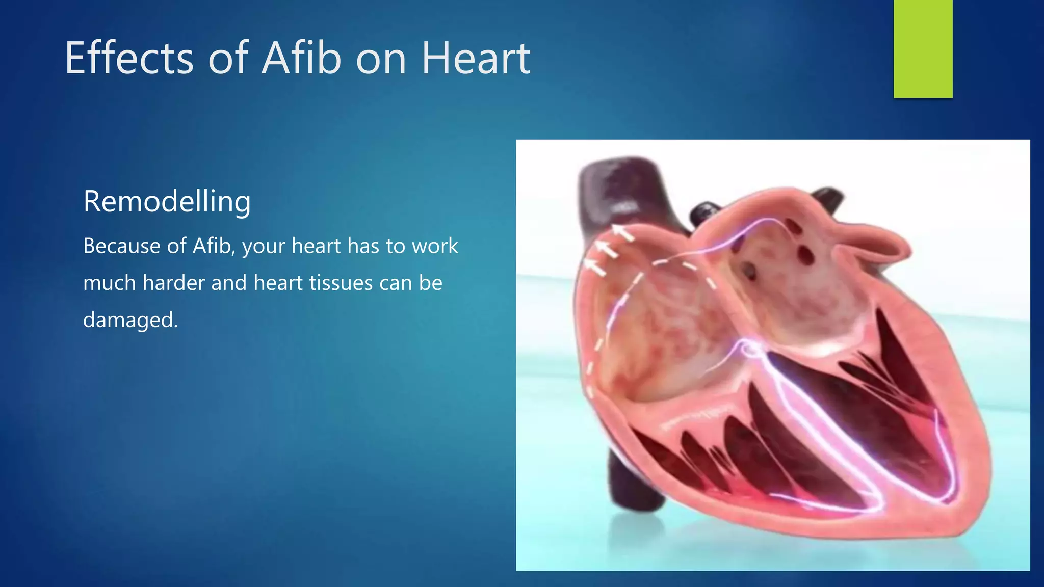 Atrial fibrillation (arrhythmia) | PPTX