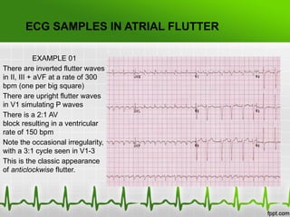 Atrial fibrillation & Atrial flutter.pptx
