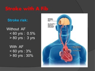 Stroke with A Fib
Stroke risk:
Without AF
< 60 yrs : 0.5%
> 80 yrs : 3 yrs
With AF
< 60 yrs : 3%
> 80 yrs : 30%
 
