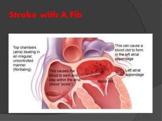 Stroke with A Fib
 