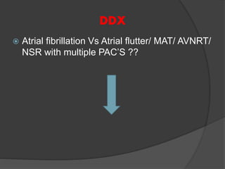DDX
 Atrial fibrillation Vs Atrial flutter/ MAT/ AVNRT/
NSR with multiple PAC’S ??
 