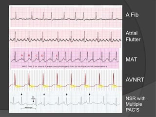 Definition A Fib
Atrial
Flutter
MAT
AVNRT
NSR with
Multiple
PAC’S
Atrial flutter
 