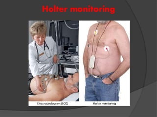 Holter monitoring
 