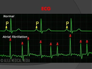 ECG
 