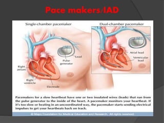 Pace makers/IAD
 
