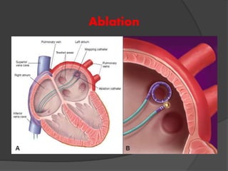 Ablation
 