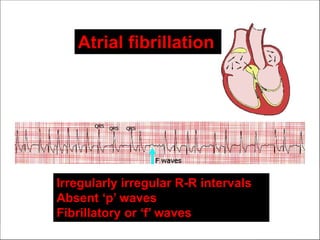 Definition
 Atrial fibrillation(AF or A fib), is a
supraventricular arrhythmia characterised
electrocardiographically by low-amplitude
baseline oscillations(fibrillatory or ‘f’ waves)
and an irregularly irregular ventricular rhythm.
 Atrial fibrillation Vs Atrial flutter??
Irregularly irregular R-R intervals
Absent ‘p’ waves
Fibrillatory or ‘f’ waves
Atrial fibrillation
 