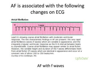 AF is associated with the following
changes on ECG

AF with f waves

 
