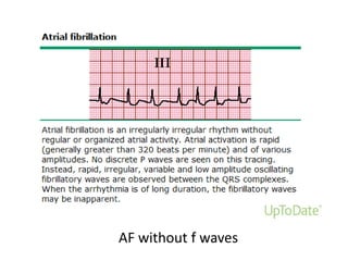 AF without f waves

 